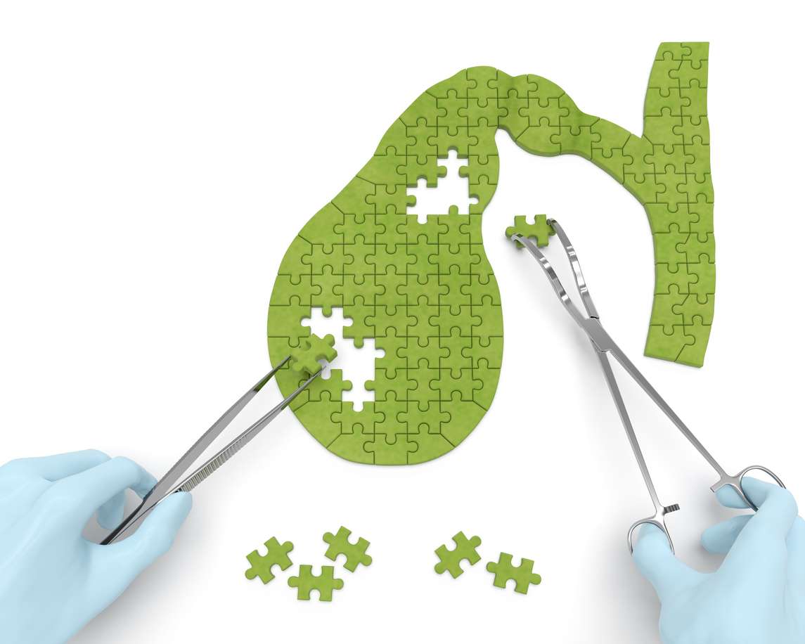 Gallbladder puzzle concept: hands of surgeon with surgical instruments (tools) performs gallbladder surgery as a result of cholelithiasis, cholecystitis, cholecystectomy, biliary dyskinesia