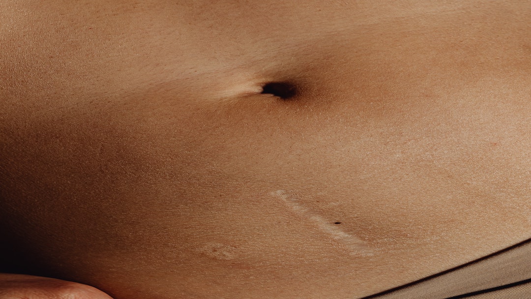 Scar Tissue: Why Treatment is Important